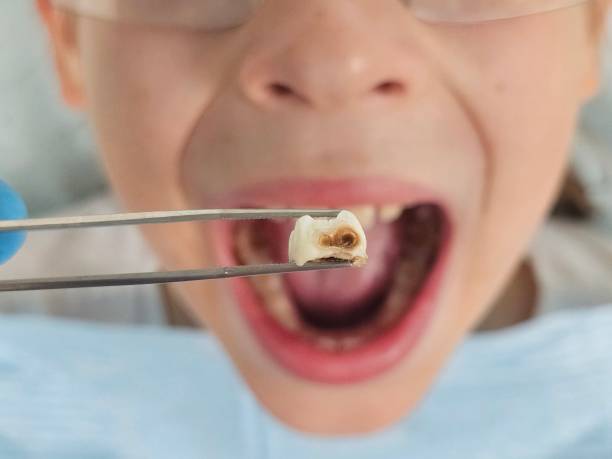 Best Knocked-Out Tooth (Avulsed Tooth) Treatment in Fort Lee, NJ